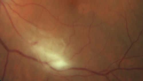 Acquired Toxoplasmosis Retinitis Para Foveal - Following Venison Consumption
56 year old man who became very sick after eating venison at the end of December 2019.  Presented 6 weeks later with a scotoma.  Initial photos show presentation with 20/63 vision.  Vision dropped to 5/200.  All tests (including PCR of anterior chamber tap) were negative except serum toxoplasmosis IgG and IgM.  Vision improved to 20/32 but the scotoma remained on oral trimetheprim/sulfa
