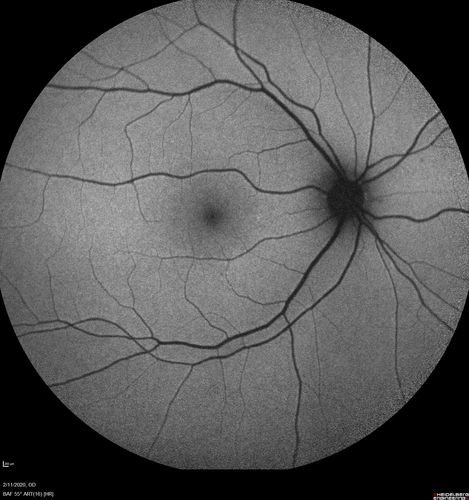 Acquired Toxoplasmosis Retinitis Para Foveal - Following Venison Consumption
56 year old man who became very sick after eating venison at the end of December 2019.  Presented 6 weeks later with a scotoma.  Initial photos show presentation with 20/63 vision.  Vision dropped to 5/200.  All tests (including PCR of anterior chamber tap) were negative except serum toxoplasmosis IgG and IgM.  Vision improved to 20/32 but the scotoma remained on oral trimetheprim/sulfa
