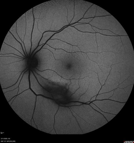 Acquired Toxoplasmosis Retinitis Para Foveal - Following Venison Consumption
56 year old man who became very sick after eating venison at the end of December 2019.  Presented 6 weeks later with a scotoma.  Initial photos show presentation with 20/63 vision.  Vision dropped to 5/200.  All tests (including PCR of anterior chamber tap) were negative except serum toxoplasmosis IgG and IgM.  Vision improved to 20/32 but the scotoma remained on oral trimetheprim/sulfa
