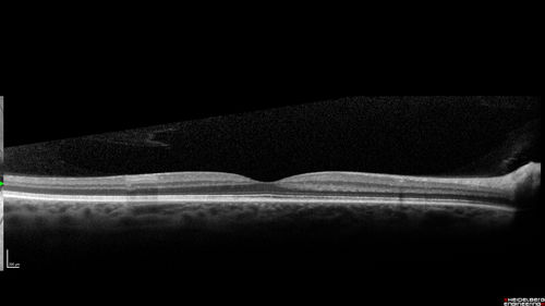 Acquired Toxoplasmosis Retinitis Para Foveal - Following Venison Consumption
56 year old man who became very sick after eating venison at the end of December 2019.  Presented 6 weeks later with a scotoma.  Initial photos show presentation with 20/63 vision.  Vision dropped to 5/200.  All tests (including PCR of anterior chamber tap) were negative except serum toxoplasmosis IgG and IgM.  Vision improved to 20/32 but the scotoma remained on oral trimetheprim/sulfa
