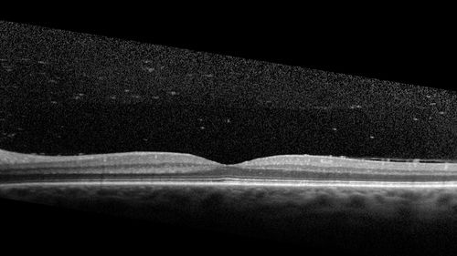 Acquired Toxoplasmosis Retinitis Para Foveal - Following Venison Consumption
56 year old man who became very sick after eating venison at the end of December 2019.  Presented 6 weeks later with a scotoma.  Initial photos show presentation with 20/63 vision.  Vision dropped to 5/200.  All tests (including PCR of anterior chamber tap) were negative except serum toxoplasmosis IgG and IgM.  Vision improved to 20/32 but the scotoma remained on oral trimetheprim/sulfa
