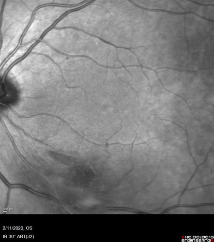 Acquired Toxoplasmosis Retinitis Para Foveal - Following Venison Consumption
56 year old man who became very sick after eating venison at the end of December 2019.  Presented 6 weeks later with a scotoma.  Initial photos show presentation with 20/63 vision.  Vision dropped to 5/200.  All tests (including PCR of anterior chamber tap) were negative except serum toxoplasmosis IgG and IgM.  Vision improved to 20/32 but the scotoma remained on oral trimetheprim/sulfa

