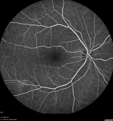 Acquired Toxoplasmosis Retinitis Para Foveal - Following Venison Consumption
56 year old man who became very sick after eating venison at the end of December 2019.  Presented 6 weeks later with a scotoma.  Initial photos show presentation with 20/63 vision.  Vision dropped to 5/200.  All tests (including PCR of anterior chamber tap) were negative except serum toxoplasmosis IgG and IgM.  Vision improved to 20/32 but the scotoma remained on oral trimetheprim/sulfa
