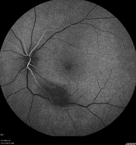 Acquired Toxoplasmosis Retinitis Para Foveal - Following Venison Consumption
56 year old man who became very sick after eating venison at the end of December 2019.  Presented 6 weeks later with a scotoma.  Initial photos show presentation with 20/63 vision.  Vision dropped to 5/200.  All tests (including PCR of anterior chamber tap) were negative except serum toxoplasmosis IgG and IgM.  Vision improved to 20/32 but the scotoma remained on oral trimetheprim/sulfa
