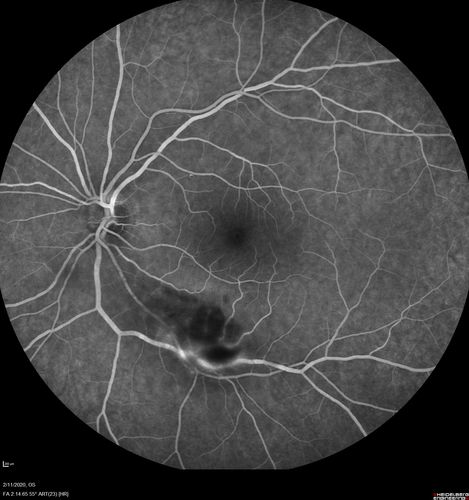 Acquired Toxoplasmosis Retinitis Para Foveal - Following Venison Consumption
56 year old man who became very sick after eating venison at the end of December 2019.  Presented 6 weeks later with a scotoma.  Initial photos show presentation with 20/63 vision.  Vision dropped to 5/200.  All tests (including PCR of anterior chamber tap) were negative except serum toxoplasmosis IgG and IgM.  Vision improved to 20/32 but the scotoma remained on oral trimetheprim/sulfa
