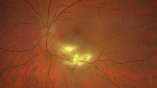 Acquired Toxoplasmosis Retinitis Para Foveal - Following Venison Consumption
56 year old man who became very sick after eating venison at the end of December 2019.  Presented 6 weeks later with a scotoma.  Initial photos show presentation with 20/63 vision.  Vision dropped to 5/200.  All tests (including PCR of anterior chamber tap) were negative except serum toxoplasmosis IgG and IgM.  Vision improved to 20/32 but the scotoma remained on oral trimetheprim/sulfa
