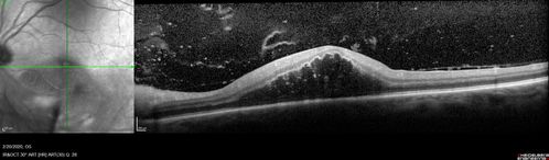 Acquired Toxoplasmosis Retinitis Para Foveal - Following Venison Consumption
56 year old man who became very sick after eating venison at the end of December 2019.  Presented 6 weeks later with a scotoma.  Initial photos show presentation with 20/63 vision.  Vision dropped to 5/200.  All tests (including PCR of anterior chamber tap) were negative except serum toxoplasmosis IgG and IgM.  Vision improved to 20/32 but the scotoma remained on oral trimetheprim/sulfa
