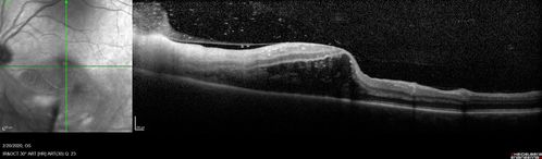 Acquired Toxoplasmosis Retinitis Para Foveal - Following Venison Consumption
56 year old man who became very sick after eating venison at the end of December 2019.  Presented 6 weeks later with a scotoma.  Initial photos show presentation with 20/63 vision.  Vision dropped to 5/200.  All tests (including PCR of anterior chamber tap) were negative except serum toxoplasmosis IgG and IgM.  Vision improved to 20/32 but the scotoma remained on oral trimetheprim/sulfa
