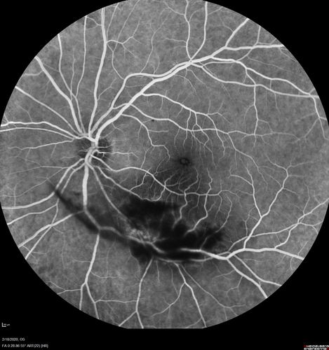 Acquired Toxoplasmosis Retinitis Para Foveal - Following Venison Consumption
56 year old man who became very sick after eating venison at the end of December 2019.  Presented 6 weeks later with a scotoma.  Initial photos show presentation with 20/63 vision.  Vision dropped to 5/200.  All tests (including PCR of anterior chamber tap) were negative except serum toxoplasmosis IgG and IgM.  Vision improved to 20/32 but the scotoma remained on oral trimetheprim/sulfa
