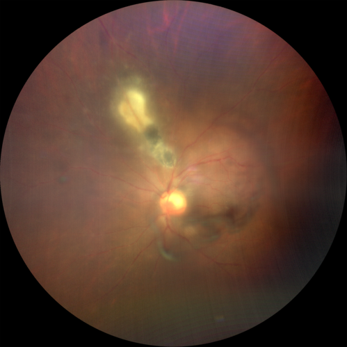 Recurrent Toxoplasmosis - Resolves with no treatment 
36 year old man with recent vision loss.  He has a sulfa allergy.  The eye was NOT treated and the uveitis resolved in about 6 weeks.
