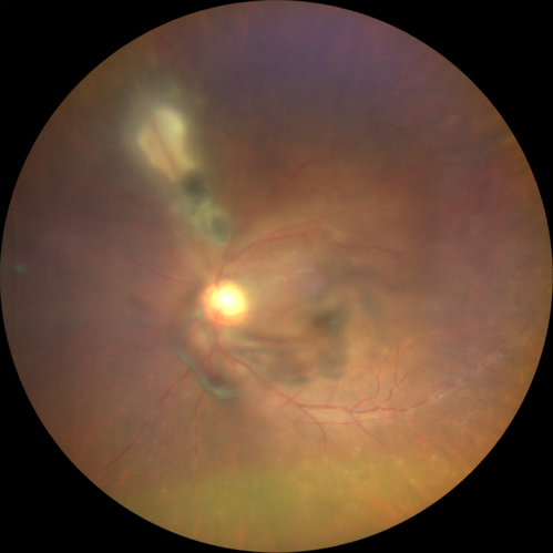 Recurrent Toxoplasmosis - Resolves with no treatment
36 year old man with recent vision loss.  He has a sulfa allergy.  The eye was NOT treated and the uveitis resolved in about 6 weeks.
