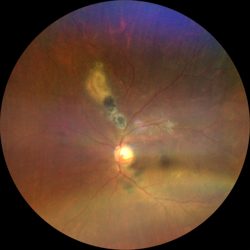 Recurrent Toxoplasmosis - Resolves with no treatment - 1 month follow-up no treatment - vision is better
36 year old man with recent vision loss.  He has a sulfa allergy.  The eye was NOT treated and the uveitis resolved in about 6 weeks.
