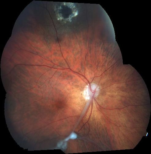 Toxocariasis - Stalk from optic nerve to peripheral scar
