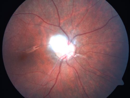 Toxocariasis
15-year-old one year ago  had pink eye then her vision has been abnormal.  She recently went for a driversâ€™ test and failed,  OD:  20/80;  OS:  20/20. 
Keywords: Toxocariasis
