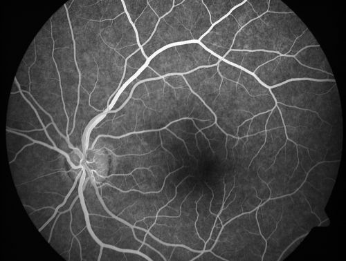 Toxocariasis
15-year-old one year ago  had pink eye then her vision has been abnormal.  She recently went for a driversâ€™ test and failed,  OD:  20/80;  OS:  20/20. 
Keywords: Toxocariasis
