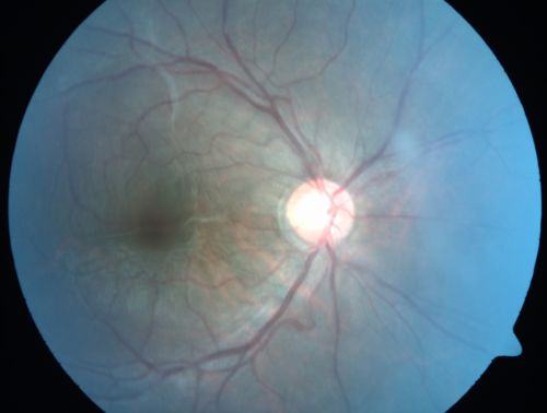 Congenital Toxoplasmosis with non-macular Scars Both Eyes - Recent Reactivation (recurrence) Right Eye
34-year-old man has congenital toxoplasmosis with four week history of foggy vision and new floaters in the right eye. OD is 20/40, OS 20/30
