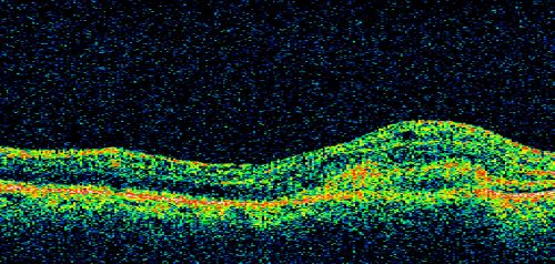 New Subfoveal Classic CNVM OS - Wet AMD - Macular Scar Congenital Toxoplasmosis Right Eye 
77-year-old woman as had poor vision in the right eye since birth from congenital toxoplasmosis of her macula in the right eye.   Two to three weeks ago when she noticed vision loss in the left eye. VISUAL ACUITY:  OD 2/200,  OS 20/200.
