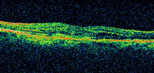 New Subfoveal Classic CNVM OS - Wet AMD - Macular Scar Congenital Toxoplasmosis Right Eye 
77-year-old woman as had poor vision in the right eye since birth from congenital toxoplasmosis of her macula in the right eye.   Two to three weeks ago when she noticed vision loss in the left eye. VISUAL ACUITY:  OD 2/200,  OS 20/200.
