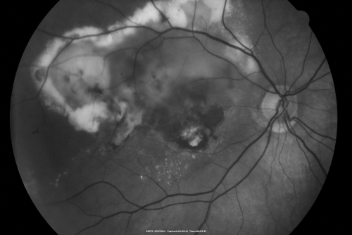 New Subfoveal Classic CNVM OS - Wet AMD - Macular Scar Congenital Toxoplasmosis Right Eye 
77-year-old woman as had poor vision in the right eye since birth from congenital toxoplasmosis of her macula in the right eye.   Two to three weeks ago when she noticed vision loss in the left eye. VISUAL ACUITY:  OD 2/200,  OS 20/200.
