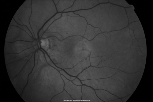 New Subfoveal Classic CNVM OS - Wet AMD - Macular Scar Congenital Toxoplasmosis Right Eye 
77-year-old woman as had poor vision in the right eye since birth from congenital toxoplasmosis of her macula in the right eye.   Two to three weeks ago when she noticed vision loss in the left eye. VISUAL ACUITY:  OD 2/200,  OS 20/200.
