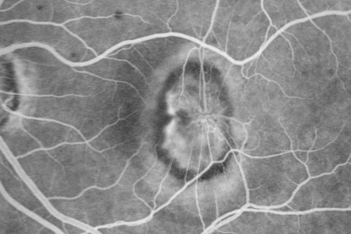 New Subfoveal Classic CNVM OS - Wet AMD - Macular Scar Congenital Toxoplasmosis Right Eye 
77-year-old woman as had poor vision in the right eye since birth from congenital toxoplasmosis of her macula in the right eye.   Two to three weeks ago when she noticed vision loss in the left eye. VISUAL ACUITY:  OD 2/200,  OS 20/200.

