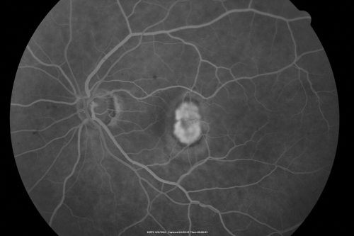 New Subfoveal Classic CNVM OS - Wet AMD - Macular Scar Congenital Toxoplasmosis Right Eye 
77-year-old woman as had poor vision in the right eye since birth from congenital toxoplasmosis of her macula in the right eye.   Two to three weeks ago when she noticed vision loss in the left eye. VISUAL ACUITY:  OD 2/200,  OS 20/200.
