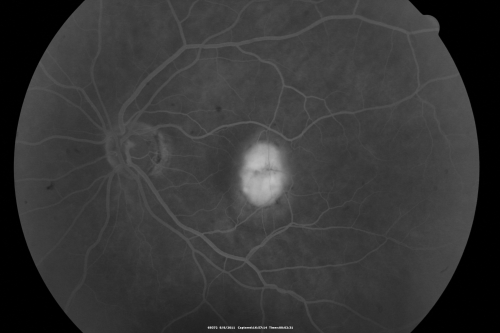 New Subfoveal Classic CNVM OS - Wet AMD - Macular Scar Congenital Toxoplasmosis Right Eye 
77-year-old woman as had poor vision in the right eye since birth from congenital toxoplasmosis of her macula in the right eye.   Two to three weeks ago when she noticed vision loss in the left eye. VISUAL ACUITY:  OD 2/200,  OS 20/200.
