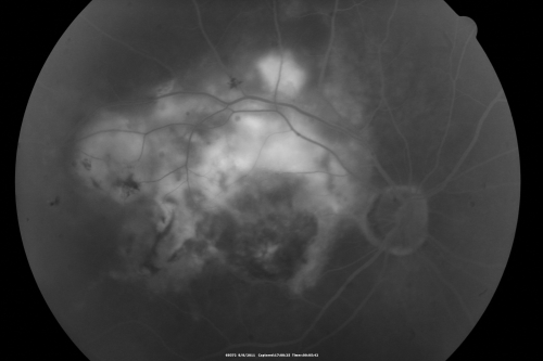 New Subfoveal Classic CNVM OS - Wet AMD - Macular Scar Congenital Toxoplasmosis Right Eye 
77-year-old woman as had poor vision in the right eye since birth from congenital toxoplasmosis of her macula in the right eye.   Two to three weeks ago when she noticed vision loss in the left eye. VISUAL ACUITY:  OD 2/200,  OS 20/200.
