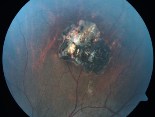 Congenital Toxoplasmosis with non-macular Scars Both Eyes - Recent Reactivation (recurrence) Right Eye
34-year-old man has congenital toxoplasmosis with four week history of foggy vision and new floaters in the right eye. OD is 20/40, OS 20/30
