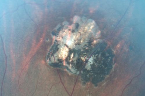 Congenital Toxoplasmosis with non-macular Scars Both Eyes - Recent Reactivation (recurrence) Right Eye
34-year-old man has congenital toxoplasmosis with four week history of foggy vision and new floaters in the right eye. OD is 20/40, OS 20/30
