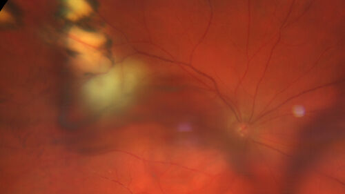 Recurrent toxoplasmosis with elevated IOP
48 year old man with 4 episodes over 40 years of vision loss from toxoplasmosis.  His IOP was 44 on presentation.
