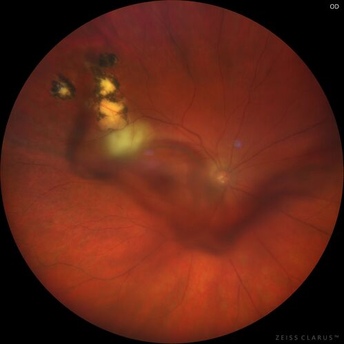 Recurrent toxoplasmosis with elevated IOP
48 year old man with 4 episodes over 40 years of vision loss from toxoplasmosis.  His IOP was 44 on presentation.
