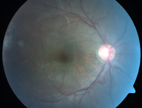 Recurrent Toxoplasmosis Right eye then Left eye 8 years later
33 year old brazilian man.  Initially presented with uveitis in the right eye in 2011.  Then in the left eye in 2019.  Since has had two more episodes.
