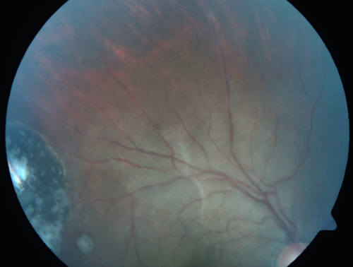 Recurrent Toxoplasmosis Right eye then Left eye 8 years later
33 year old brazilian man.  Initially presented with uveitis in the right eye in 2011.  Then in the left eye in 2019.  Since has had two more episodes.

