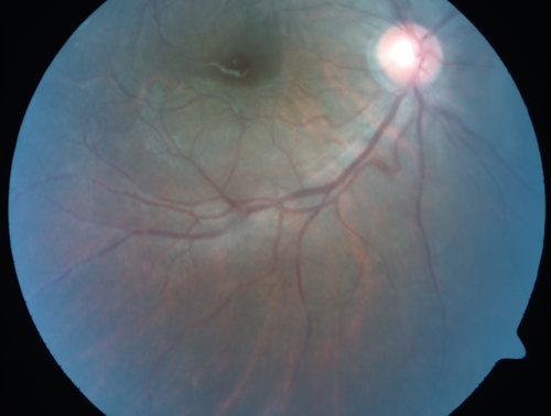 Recurrent Toxoplasmosis Right eye then Left eye 8 years later
33 year old brazilian man.  Initially presented with uveitis in the right eye in 2011.  Then in the left eye in 2019.  Since has had two more episodes.
