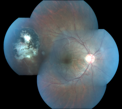 Recurrent Toxoplasmosis Right eye then Left eye 8 years later
33 year old brazilian man.  Initially presented with uveitis in the right eye in 2011.  Then in the left eye in 2019.  Since has had two more episodes.
