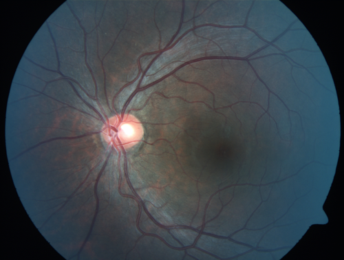 Recurrent Toxoplasmosis Right eye then Left eye 8 years later
33 year old brazilian man.  Initially presented with uveitis in the right eye in 2011.  Then in the left eye in 2019.  Since has had two more episodes.
