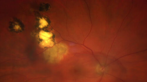 Recurrent toxoplasmosis with elevated IOP
48 year old man with 4 episodes over 40 years of vision loss from toxoplasmosis.  His IOP was 44 on presentation.
