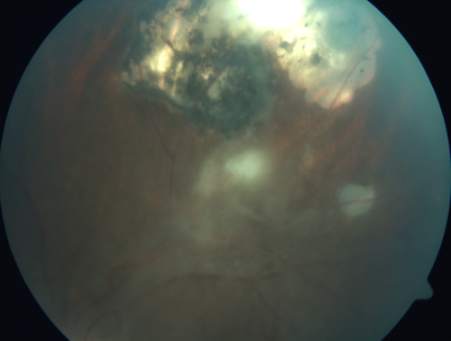 Recurrent Toxoplasmosis Right eye then Left eye 8 years later
33 year old brazilian man.  Initially presented with uveitis in the right eye in 2011.  Then in the left eye in 2019.  Since has had two more episodes.
