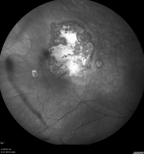 Recurrent Toxoplasmosis Right eye then Left eye 8 years later
33 year old brazilian man.  Initially presented with uveitis in the right eye in 2011.  Then in the left eye in 2019.  Since has had two more episodes.
