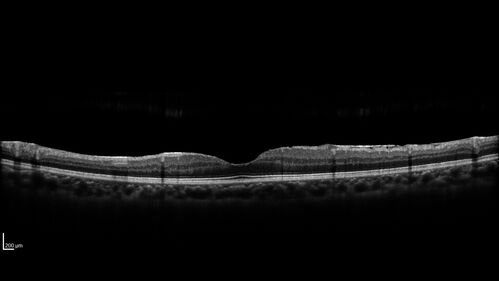 Recurrent Toxoplasmosis Right eye then Left eye 8 years later
33 year old brazilian man.  Initially presented with uveitis in the right eye in 2011.  Then in the left eye in 2019.  Since has had two more episodes.
