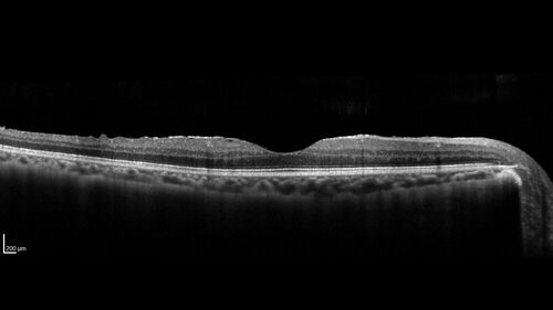 Recurrent Toxoplasmosis Right eye then Left eye 8 years later
33 year old brazilian man.  Initially presented with uveitis in the right eye in 2011.  Then in the left eye in 2019.  Since has had two more episodes.
