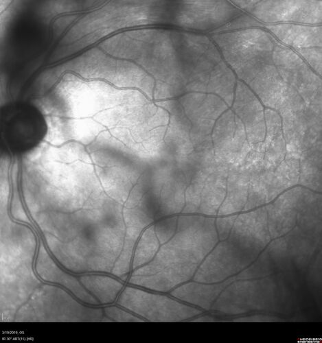 Recurrent Toxoplasmosis Right eye then Left eye 8 years later
33 year old brazilian man.  Initially presented with uveitis in the right eye in 2011.  Then in the left eye in 2019.  Since has had two more episodes.
