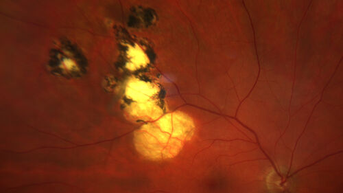 Recurrent toxoplasmosis with elevated IOP
48 year old man with 4 episodes over 40 years of vision loss from toxoplasmosis.  His IOP was 44 on presentation.
