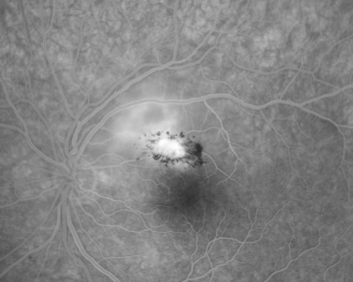 Toxoplasmosis - Inner Retinal - Recurrent - Treated with Bactrim DS 
43-year-old man has macular toxoplasmosis.   He has responded nicely to Bactrim OS:  20/60
Keywords: toxoplasmosis;retinitis;inner retina;recurrent