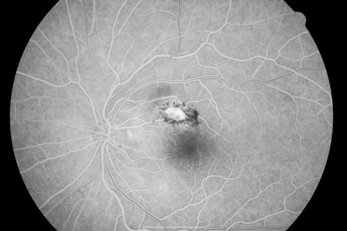 Toxoplasmosis - Inner Retinal - Recurrent - Treated with Bactrim DS 
43-year-old man has macular toxoplasmosis.   He has responded nicely to Bactrim OS:  20/60
Schlüsselwörter: toxoplasmosis;retinitis;inner retina;recurrent