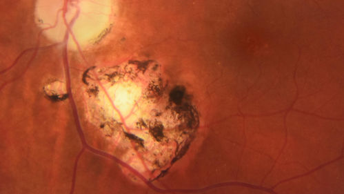Toxoplasmosis Macular Scar - Inactive
49 year old man Toxoplasmosis was diagnosed in his 20s. No past eye surgeries OU.  He had floaters a few weeks ago with dots and a long line in the vision.  Since then they have gone away.  
VA OD: Dcc20/20 NccJ1+
VA OS: Dcc20/16 NccJ1+
