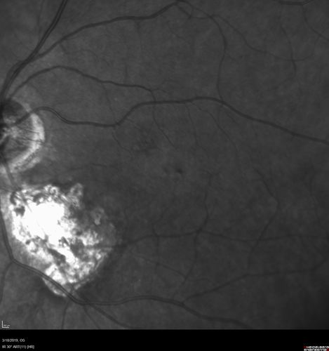 Toxoplasmosis Macular Scar - Inactive
49 year old man Toxoplasmosis was diagnosed in his 20s. No past eye surgeries OU.  He had floaters a few weeks ago with dots and a long line in the vision.  Since then they have gone away.  
VA OD: Dcc20/20 NccJ1+
VA OS: Dcc20/16 NccJ1+
