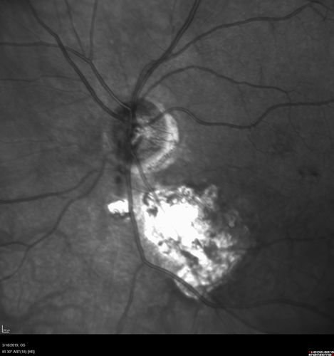 Toxoplasmosis Macular Scar - Inactive
49 year old man Toxoplasmosis was diagnosed in his 20s. No past eye surgeries OU.  He had floaters a few weeks ago with dots and a long line in the vision.  Since then they have gone away.  
VA OD: Dcc20/20 NccJ1+
VA OS: Dcc20/16 NccJ1+
