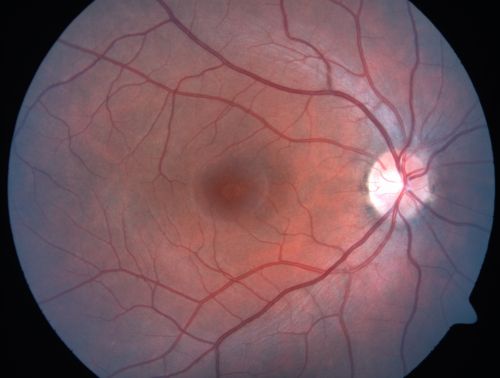 Toxoplasmosis Macular Scar (acquired not congenital) 31 Year Old Man- Recent Vision Change - Creeping Scar
31-year-old man had an episode of toxoplasmosis in the left eye, where unfortunately it adversely affected his central vision that was back in 2004 (7 years ago)
He did notice recently a change in his visual function.  He plays softball, he was getting hit by the ball and having trouble seeing and he said that is how he noticed the toxoplasmosis when it first occurred and he was concerned it might have recurred. 
OD 20/16,  OS 20/80. 

